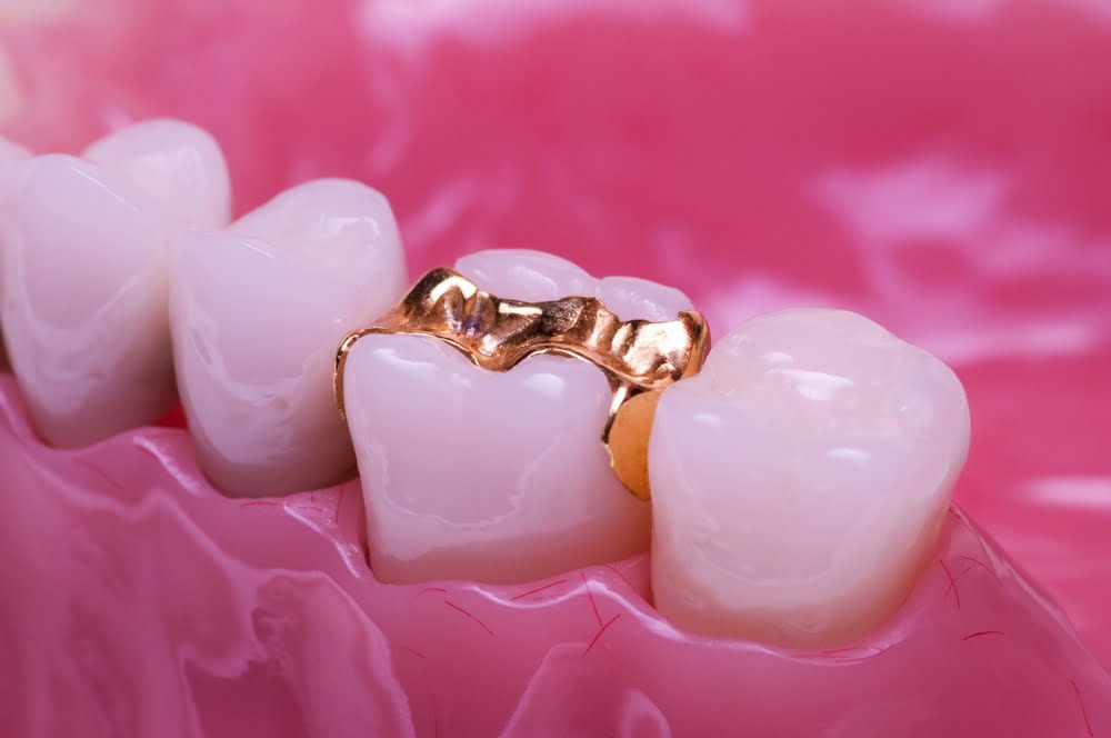 Repair Of Damaged Teeth Inlays/Onlays Pinner Road Dental